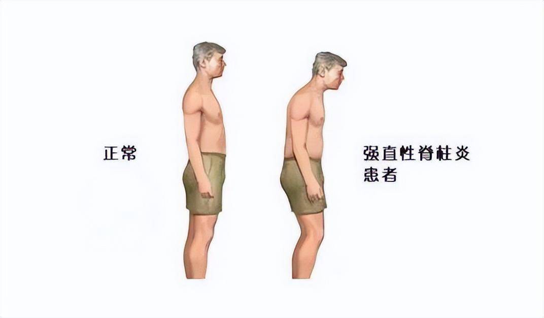 李宇6686体育春自曝感觉身体在“石化”周杰伦、蔡少芬、张嘉益都患过这种病(图1)