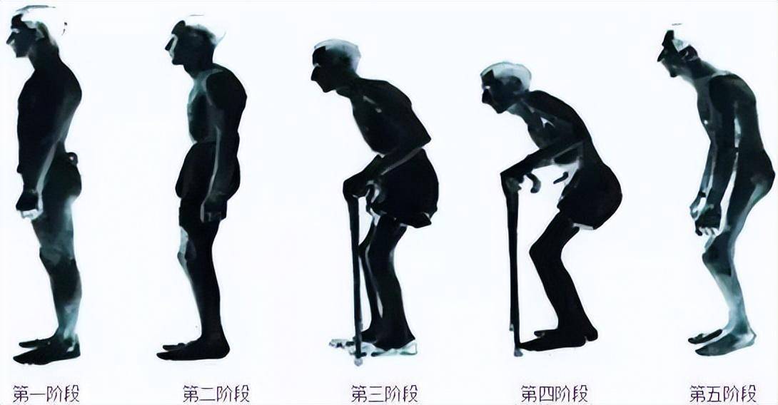 李宇6686体育春自曝感觉身体在“石化”周杰伦、蔡少芬、张嘉益都患过这种病(图3)