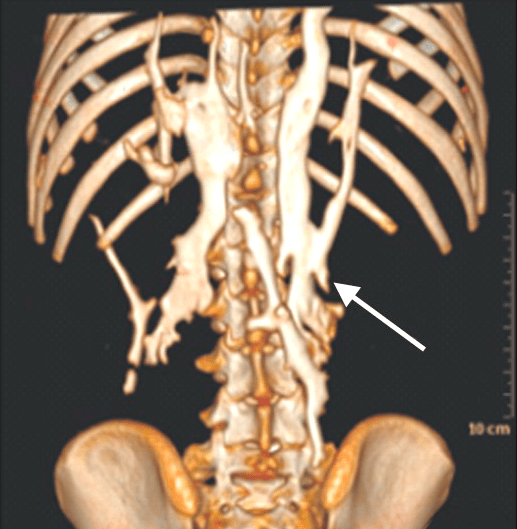 6686体育石化综合征：4 岁患儿全身肌肉变骨头11 场手术越切长得越多(图4)