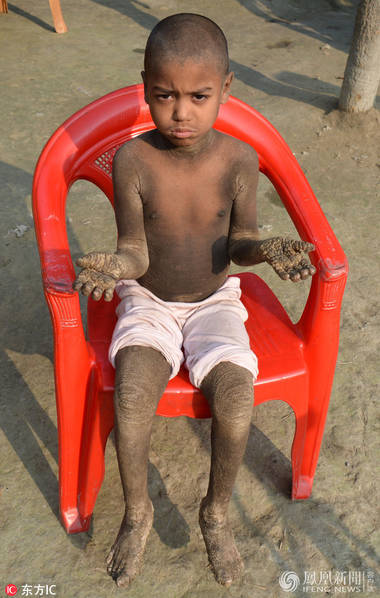 孟加拉小男孩Mehendi Hassan患有罕6686体育见皮肤病成石头人【图】(图1)