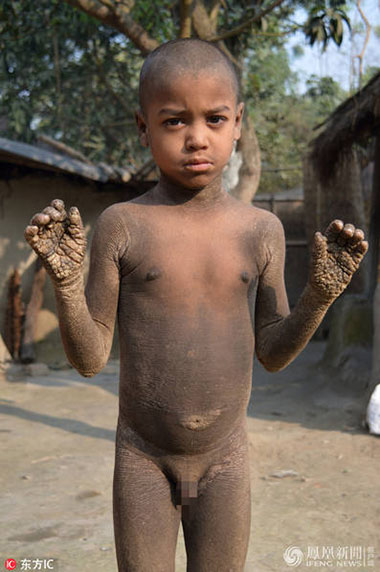 孟加拉小男孩Mehendi Hassan患有罕6686体育见皮肤病成石头人【图】(图2)