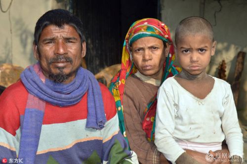 孟加拉小男孩Mehendi Hassan患有罕6686体育见皮肤病成石头人【图】(图3)